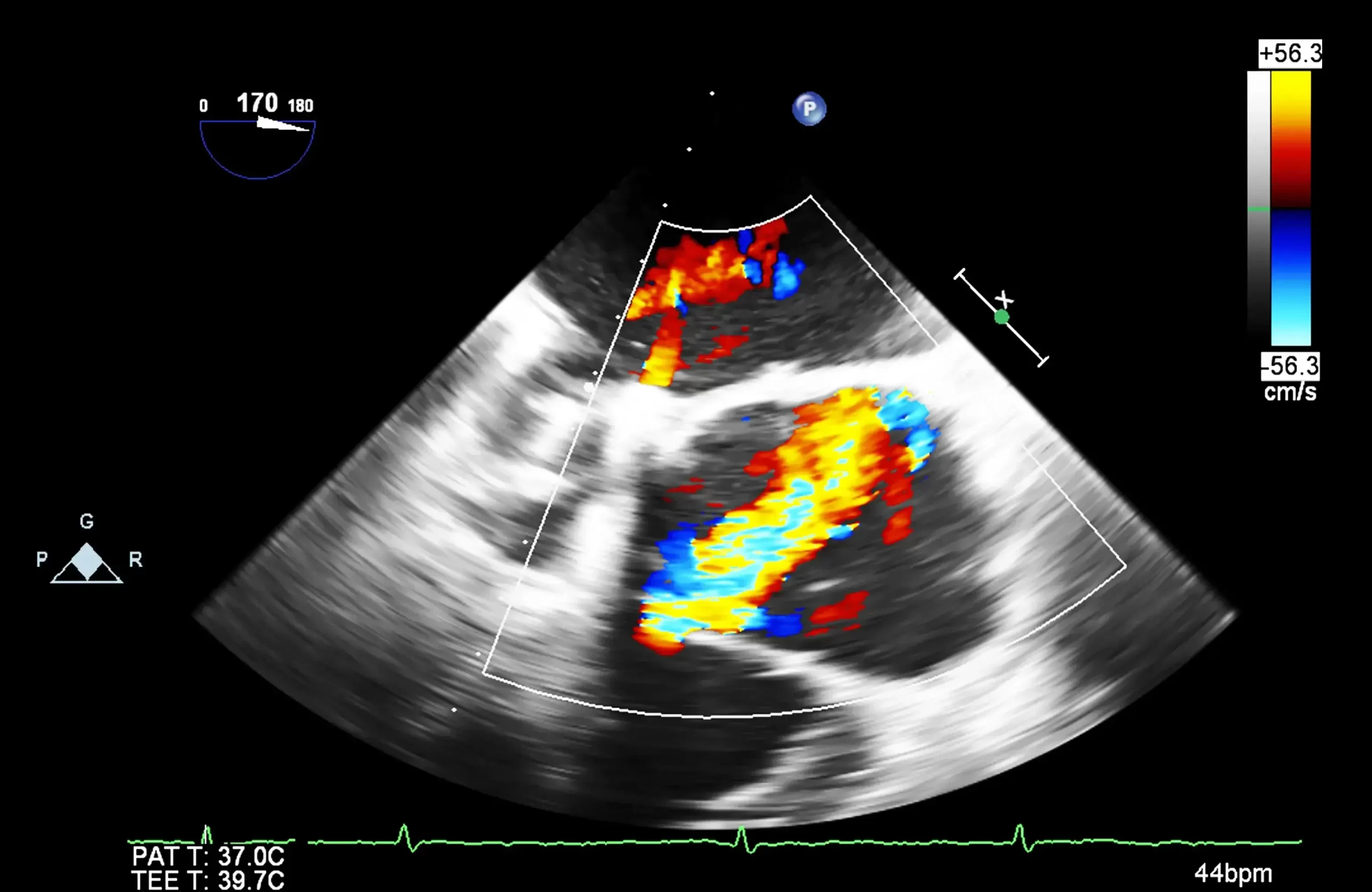 heart-transesophageal-ultrasound-iStock-1195164372-crop2
